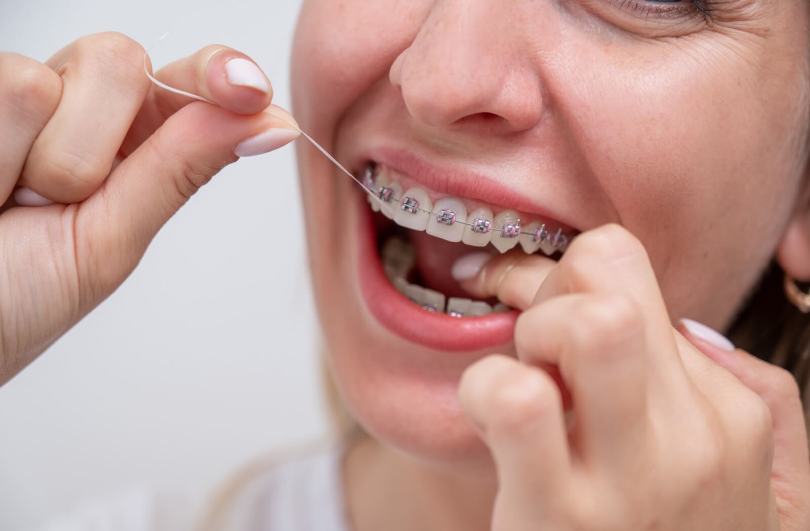 Close-up of a woman flossing her teeth with braces, showcasing proper dental hygiene while wearing orthodontic appliances.